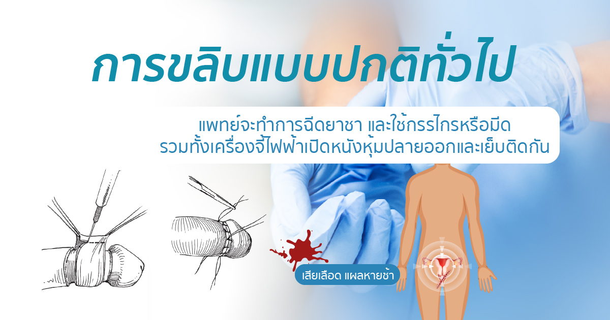 การขลิบแบบทั่วไป ขลิบไร้เลือด ขลิบอวัยวะเพศชาย หมอเบียร์ Eternity Clinic